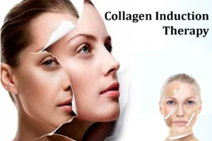 Collagen Induction Therapy (cit)