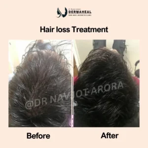 Best Hair Transplant Dwarka 2026 Guide
