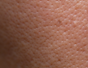 How to Get Rid of Large Pores and How to Treat Them