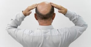 MALE PATTERN BALDNESS, & HOW IS IT TREATED?