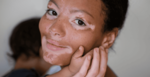 DEMYSTIFYING VITILIGO: CLEARING MISCONCEPTIONS AND STATING THE FACTS