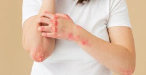 FUNGAL SKIN INFECTIONS: CAUSES, SYMPTOMS, AND TREATMENTS