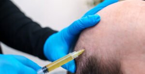 HOW SCALP MICROPIGMENTATION HELPS WITH BALD SPOTS
