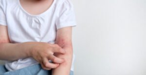 FUNGAL INFECTION IN CHILDREN : SYMPTOMS, CAUSES, AND CARE TIPS