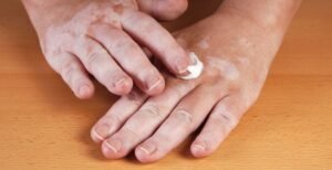 Winter Skincare for Vitiligo: Tips to Prevent Dryness and Flaking