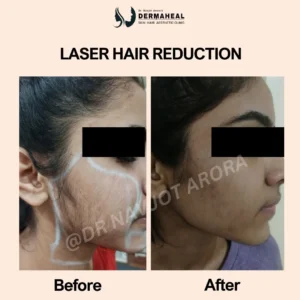 Laser Hair Reduction – 5 Powerful Benefits, Procedure & What to Expect