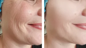 Botox – Top 5 Proven Benefits, Side Effects & How It Works