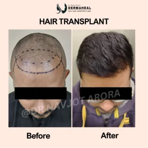 Best Hair Transplant Clinic in Dwarka – Natural Results You Can Trust