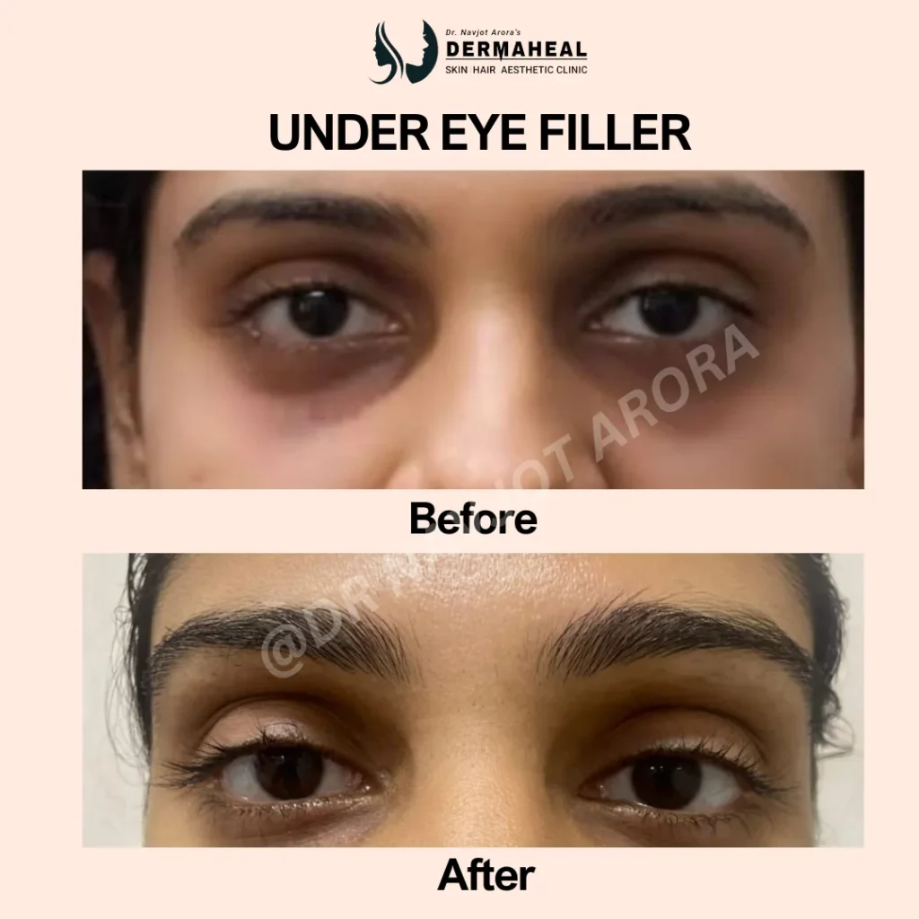 Under eye fillers at Dermaheal Skin & Hair Clinic in Dwarka, New Delhi