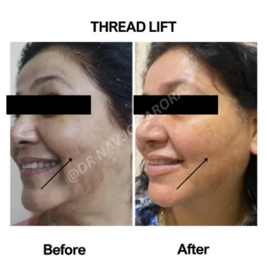 Thread Lifting – 5 Amazing Benefits, Procedure & Side Effects Explained
