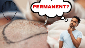 Is Hair Transplant Permanent? What Science and Experts Say