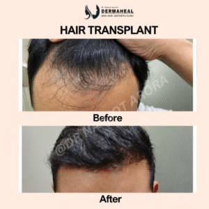 Best Hair Transplant Clinic in Dwarka – Your Trusted Destination for Hair Restoration