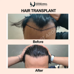 Top 5 Benefits of Getting a Hair Transplant at Dermaheal Clinic in Dwarka