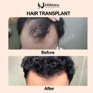 Discover the Benefits of Hair Transplant at Dermaheal Clinic