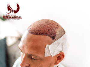 Hair Transplant in Dwarka – Natural Hair Restoration