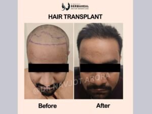 Best Hair Transplant in Dwarka: Restore Confidence with Expert Care