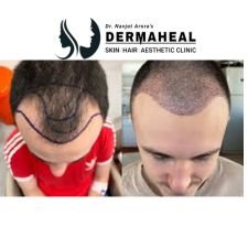 Best Hair Transplant in Dwarka: 7 Powerful Reasons to Choose Us