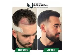 Best Hair Transplant in Dwarka: Why Dermaheal Stands Apart
