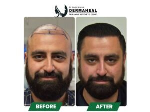 Restore Your Confidence with the Best Hair Transplant in Dwarka at Dermaheal