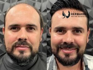Hair Transplant in Dwarka: Get Your Confidence Back