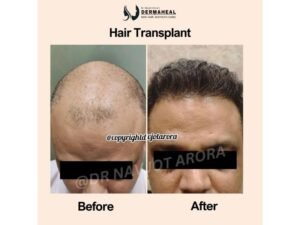 Best Hair Transplant in Dwarka – Natural & Lasting Solutions