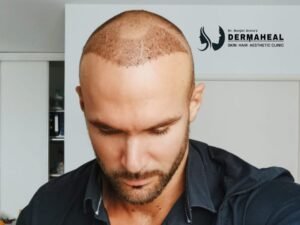 Restore Your Hair with Expert Hair Transplant in Dwarka