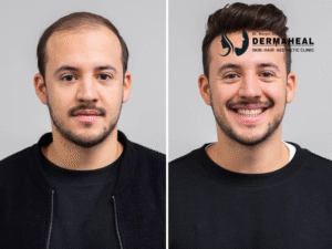 Hair Transplant in Dwarka | Expert Hair Restoration Clinic
