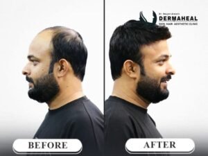Hair Transplant in Dwarka: A Complete Guide