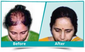 Hair Transplant in Dwarka | Expert Care at Dermaheal Clinic