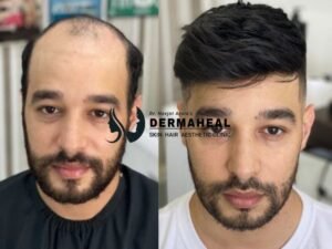8 Proven Hair Transplant in Dwarka Secrets