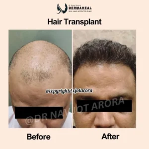 Hair Transplant in Dwarka: What to Expect Before, During & After the Procedure
