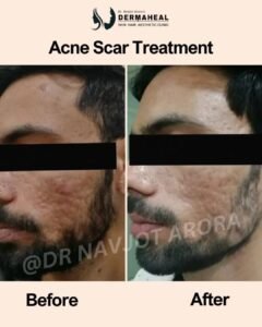 Top 5 Acne Scars Reduction Treatments in Dwarka