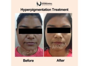 7 Best Melasma Treatments Dwarka