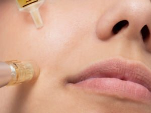 Top 5 Acne Scars Reduction Dwarka
