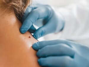 Skin Tag Removal Dwarka: Dermaheal, Dr Navjot