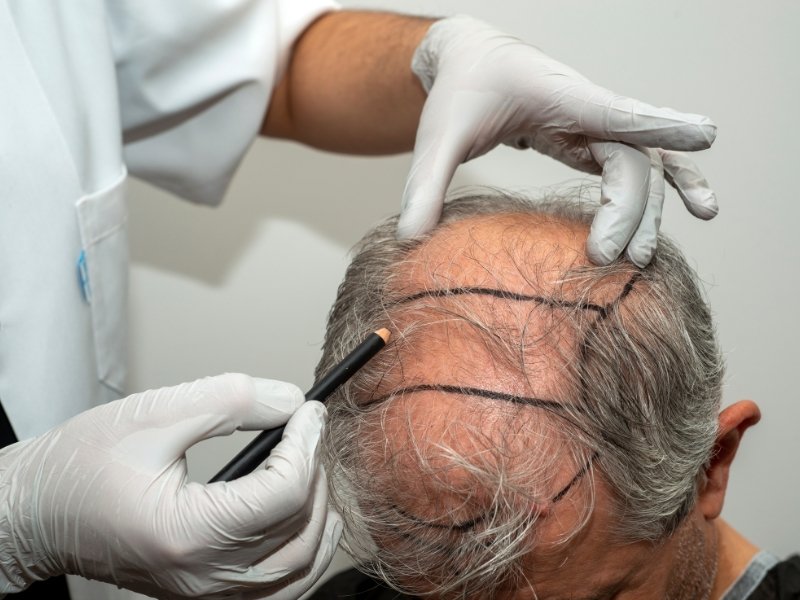 Hair Transplant in Dwarka