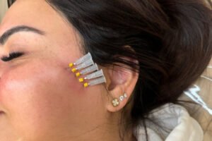 Thread Lifting Dwarka: A Modern Solution for Youthful Skin