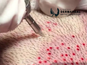 FUE Hair Transplant in Dwarka: Natural Hairline, Lasting Density & What to Know