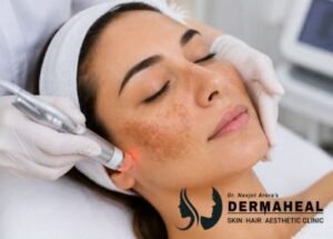 Melasma Treatment in Dwarka: What Actually Works for Indian Skin?
