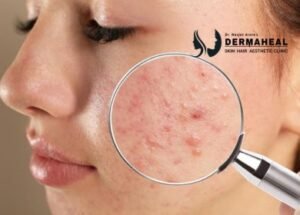 Acne Scar Treatment in Dwarka: Which Treatment Is Right for Your Skin?