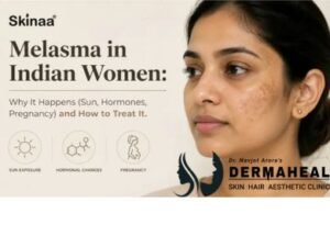 Melasma in Indian Skin: What Triggers It and How Is It Treated?
