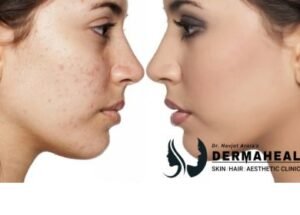 Why Do Acne Scars Get Darker After Pimples Heal?