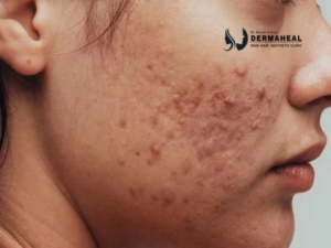 acne keeps coming back after treatment